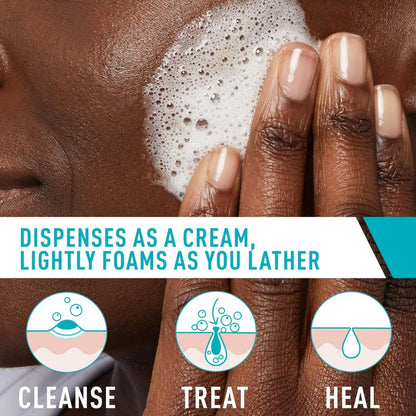CeraVe Limpiador en crema espumosa para el acné, lavado facial de peróxido de benzoilo al 4% con ácido hialurónico, niacinamida y ceramidas, tratamiento diario suave para el acné para la cara