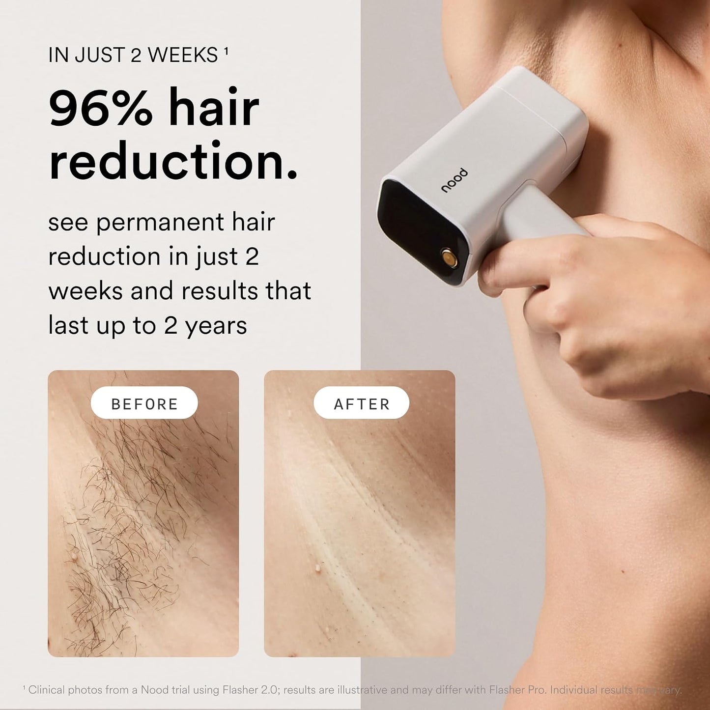 Nood™ NUEVO Flasher Pro \u2014 Dispositivo de depilación láser IPL...