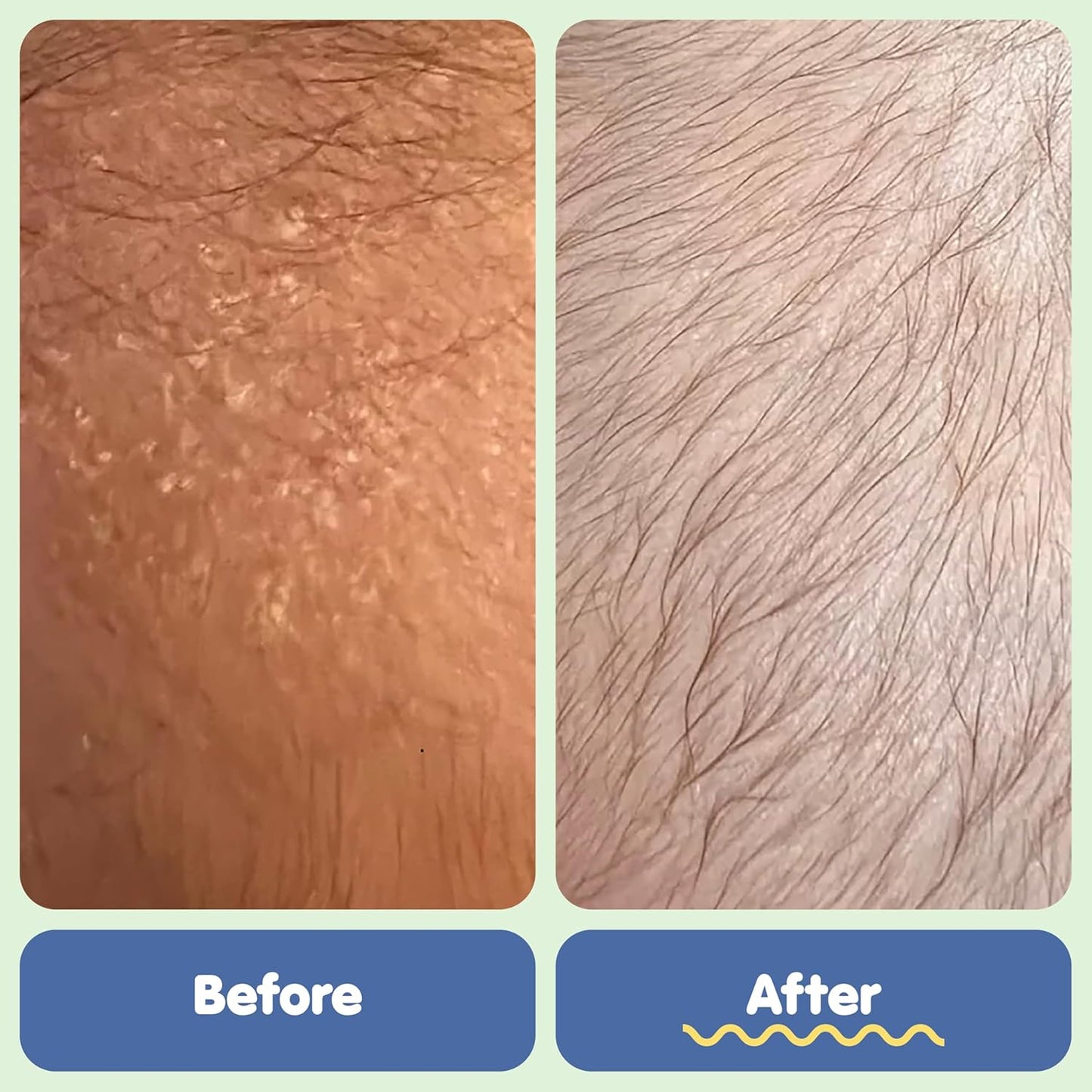TUBBY TODD Kit de tratamiento para el cabello de bebé con costra lá...