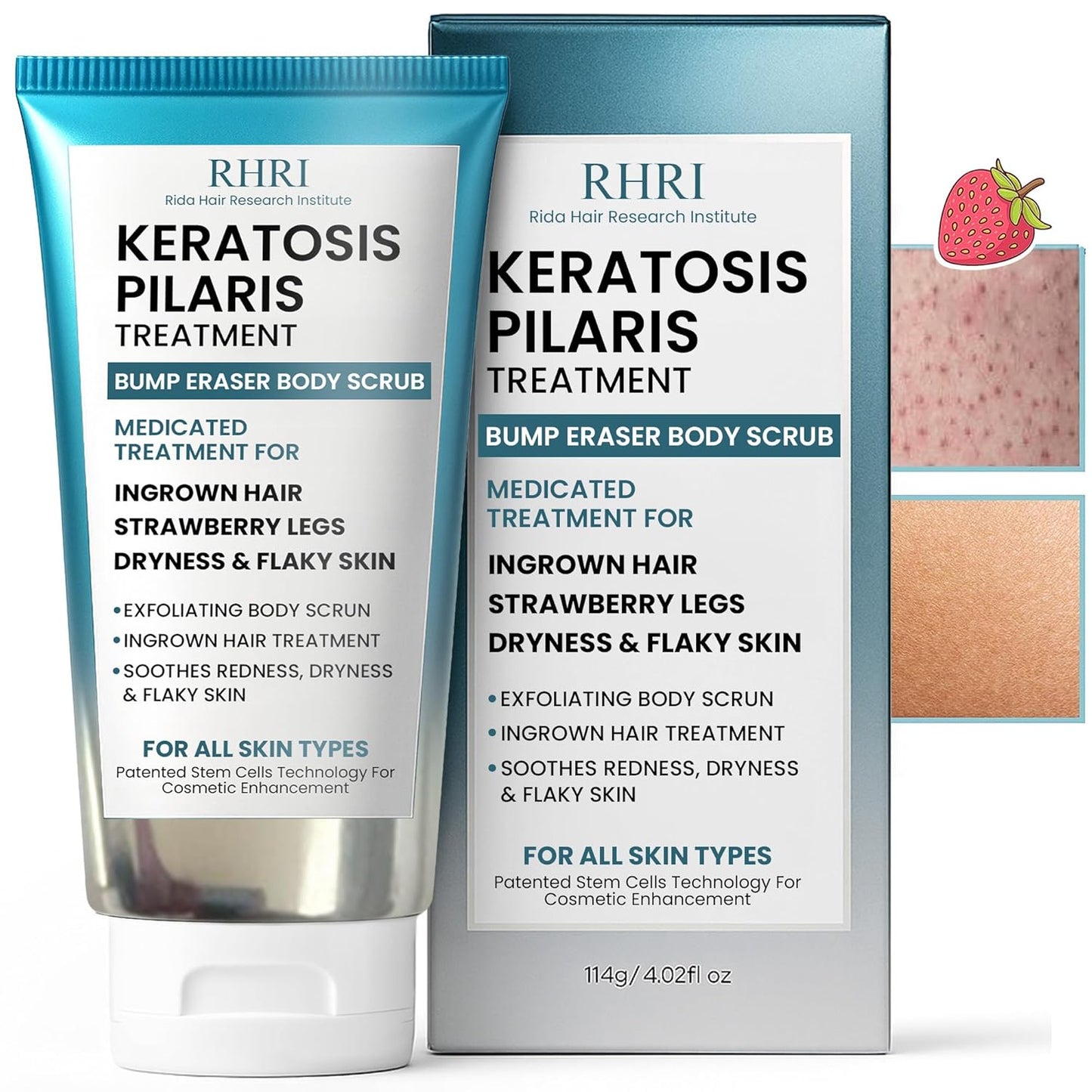 KP Bump Eraser Body Scrub con 10% AHA | Tratamiento de queratosis p...