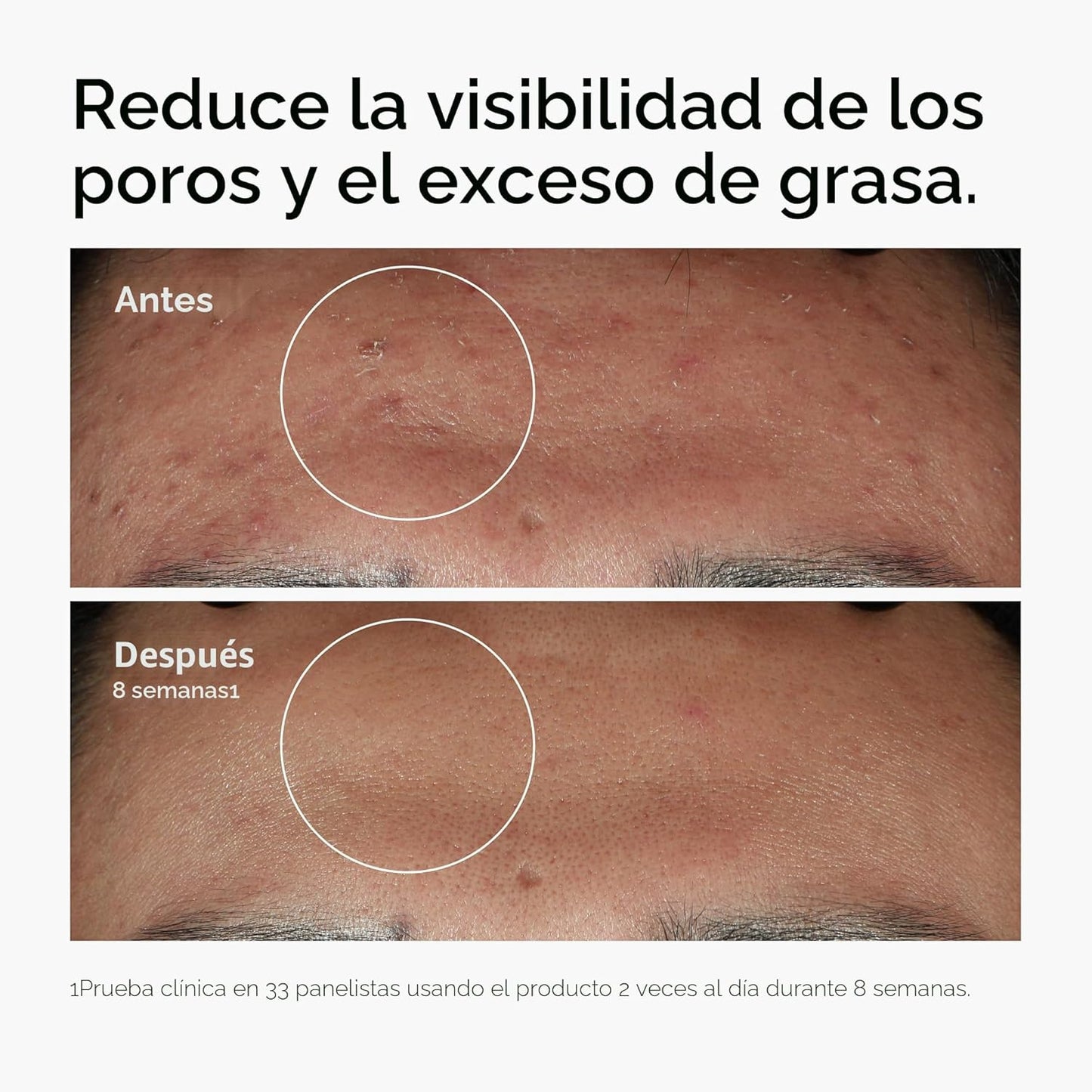 The Ordinary Niacinamide 10% + Zinc 1%, Smoothing Serum for Blemish...