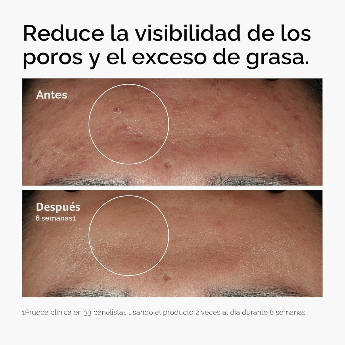 The Ordinary Niacinamide 10% + Zinc 1%, Smoothing Serum for Blemish...