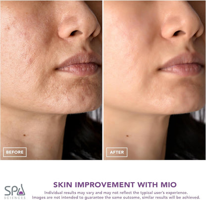 Spa Sciences - MIO - Eliminador de puntos negros de microdermoabras...