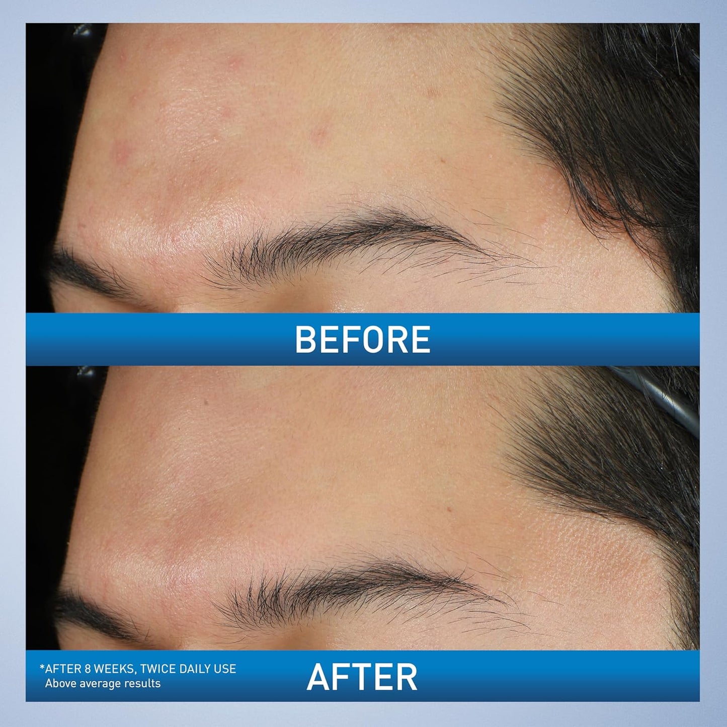 CeraVe Crema Espumosa Limpiadora para el Acné, Limpiador Suave para Rostro y Cuerpo con Peróxido de Benzoilo al 10%, Ácido Hialurónico y Niacinamida, Tratamiento con Peróxido de Benzoilo al 10% que