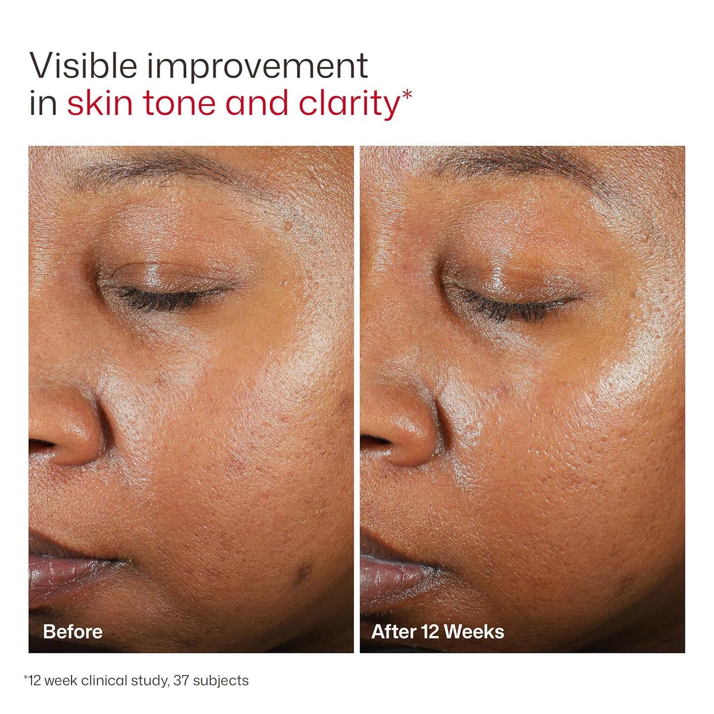 EltaMD UV Clear Face Sunscreen, Oil Free Sunscreen for Sensitive Sk...