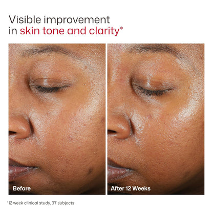 EltaMD UV Clear Face Sunscreen, Oil Free Sunscreen for Sensitive Sk...