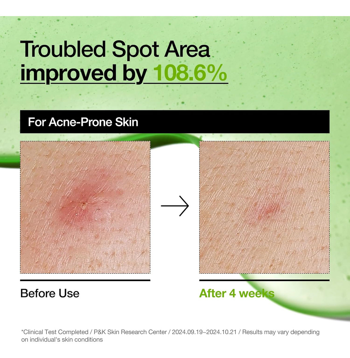 Anua Suero Facial De Ácido Azelaico 10% Hialurónico En Rojo